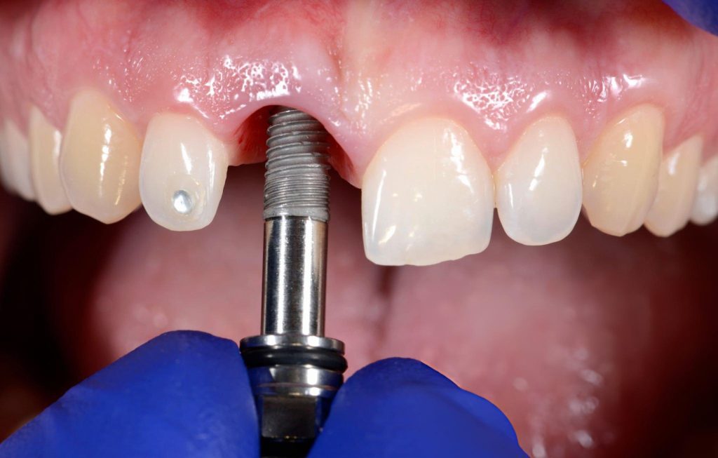How Dental Implants Improve Oral Health Beyond Just Aesthetics