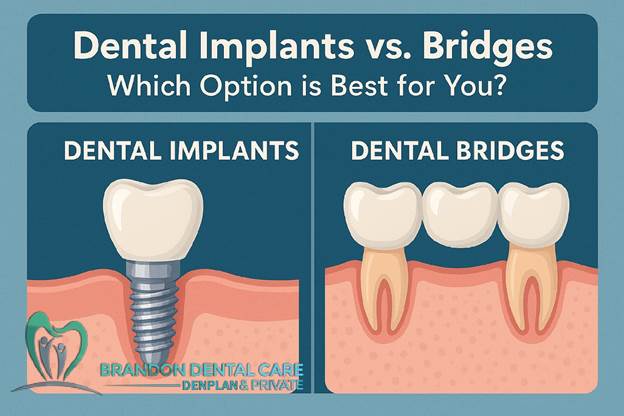 Dental Implants vs. Bridges